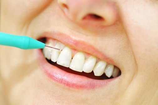 dentiste brossette interdentaire