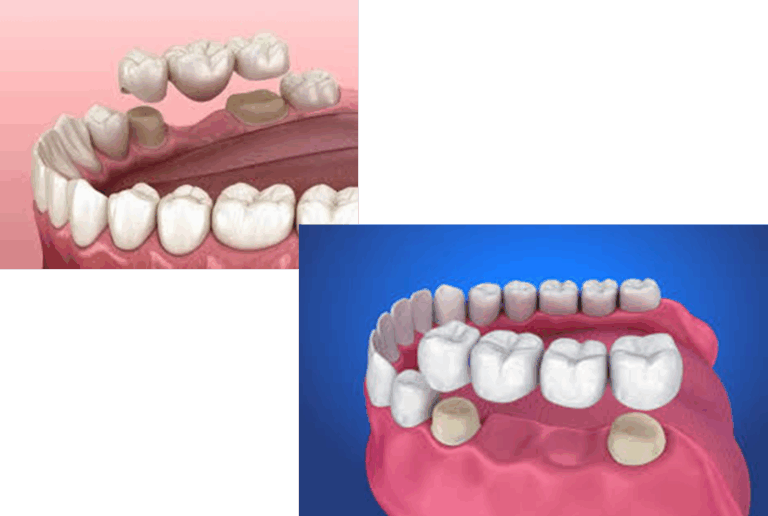 quelles solutions prothétiques ? 10 bridge