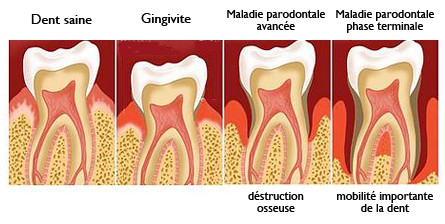 dentiste bourgogne parodontite