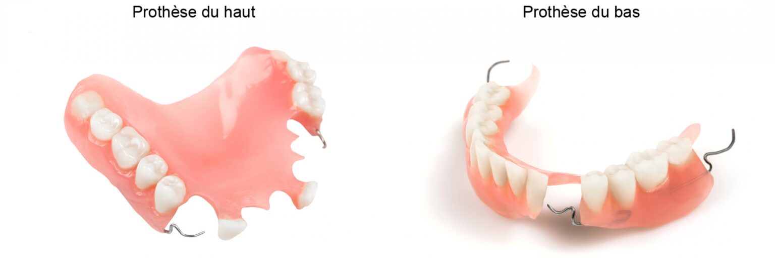 quelles solutions prothétiques ? 13 20190314_145912