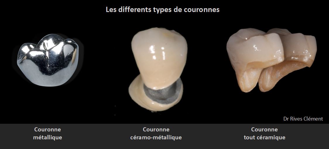 quelles solutions prothétiques ? 4 65-les-différents-types-de-couronnes
