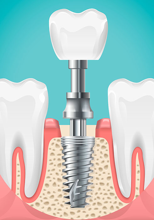 quelles solutions prothétiques ? 19 implant-dentaire-paris-dentiste