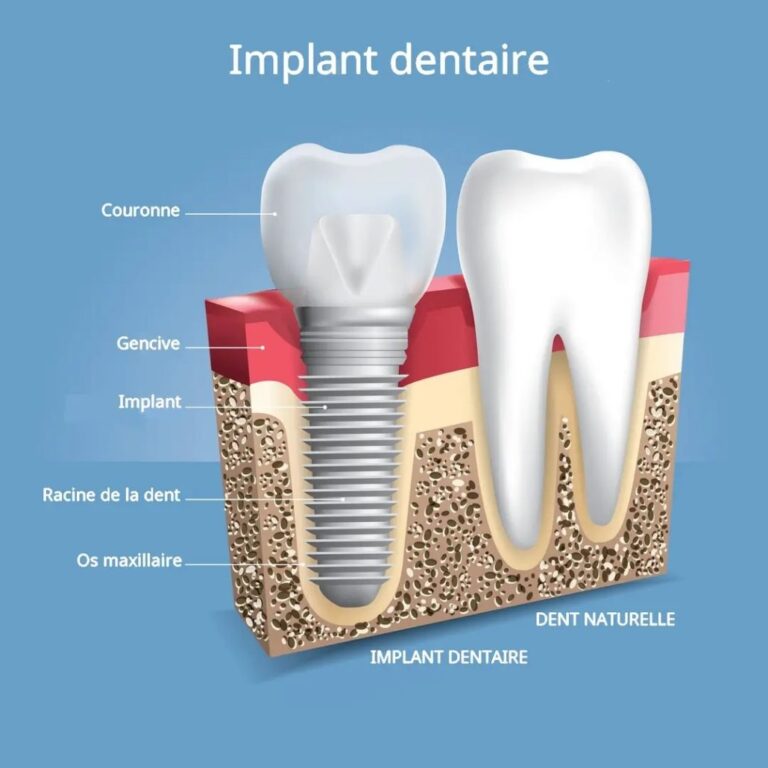 quelles solutions prothétiques ? 18 implant-1030x1030