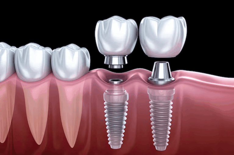 quelles solutions prothétiques ? 17 tooth-implant-process-what-to-expect
